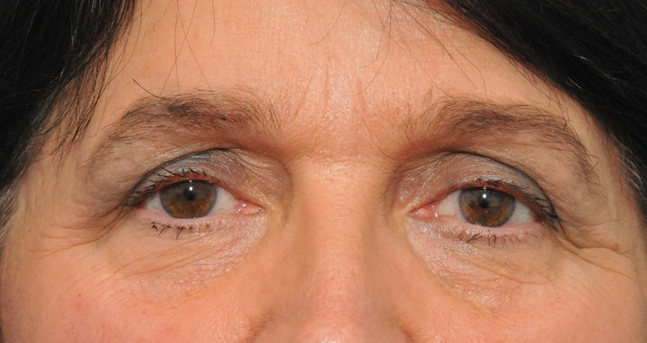 5 biến chứng nghiêm trọng thường gặp khi cắt mắt 2 mí