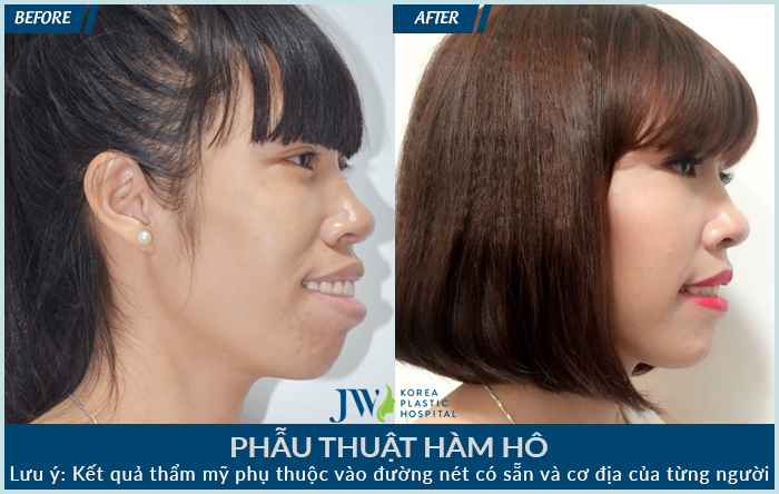 PHAU-THUAT-HAM-HO