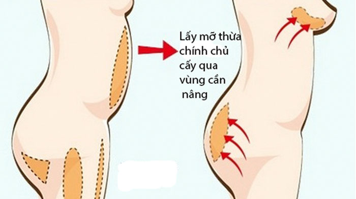 Cách nâng ngực an toàn nhất_6