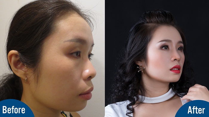 Sau khi cải thiện dáng mũi, hình ảnh Việt Trang cuốn hút hơn gấp nhiều lần