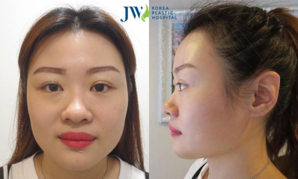 Her short and wide nose