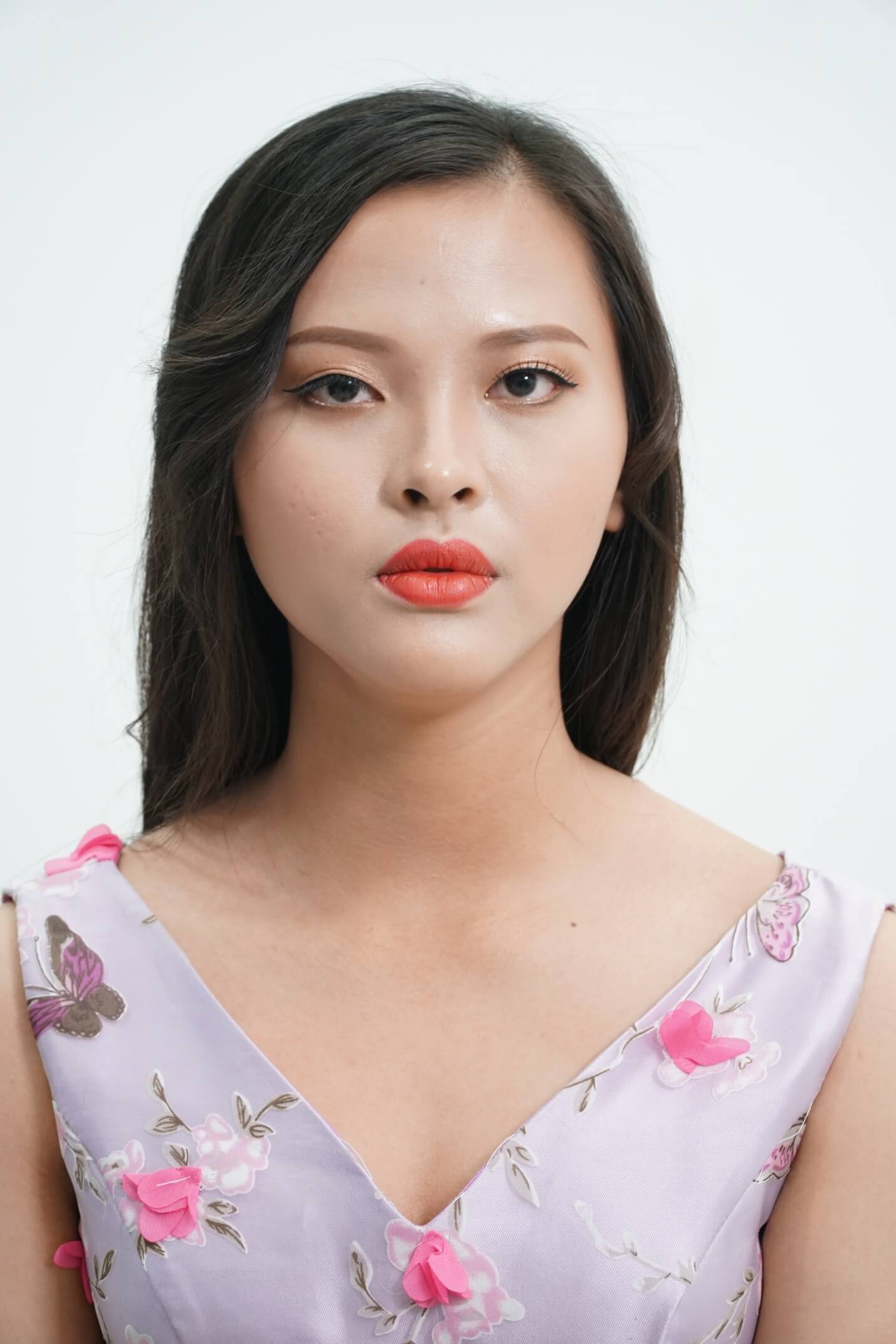 Thu Henry - Double Eyelid Surgery