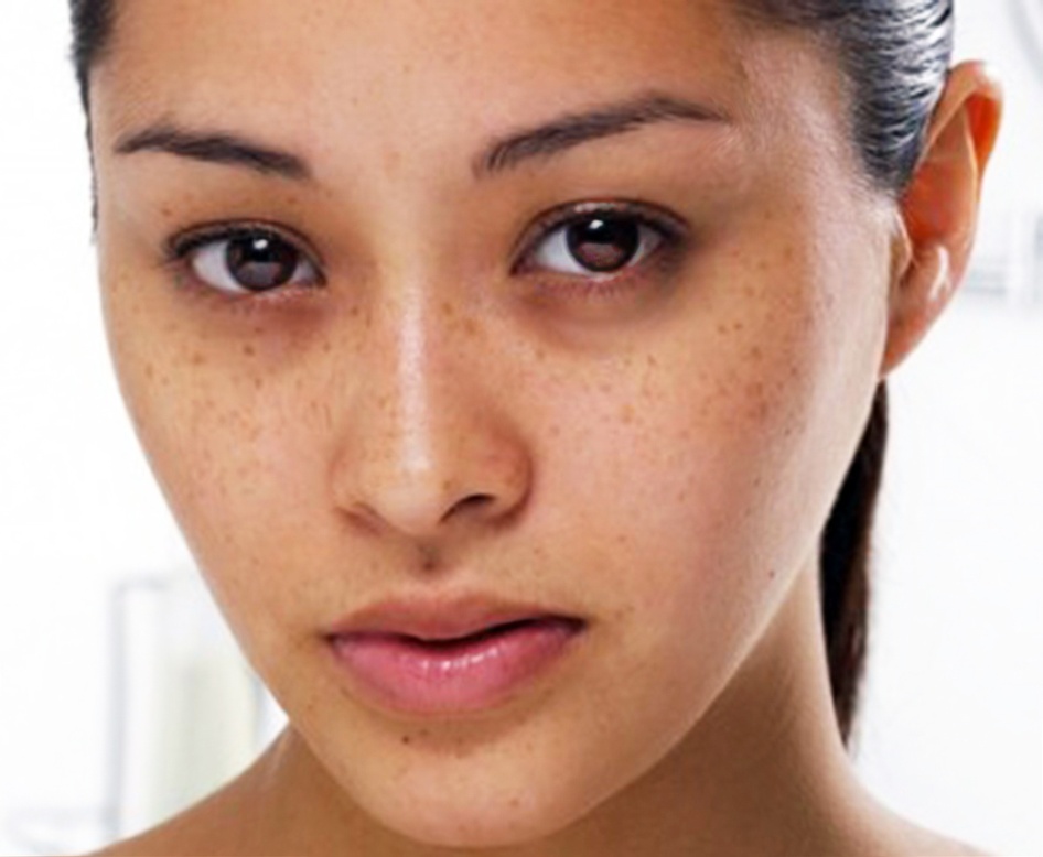 Cách trị nám da mặt sau sinh hiệu quả và an toàn - hình 2