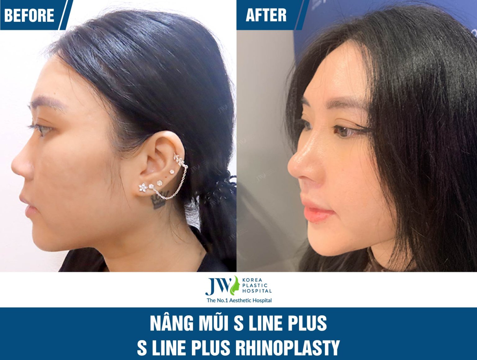 S-Line Plus Rhinoplasty: A Natural Approach to Nose Enhancement