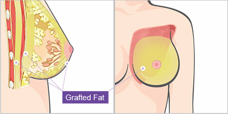 Harvest Jet 2 (Breast Augmentation)