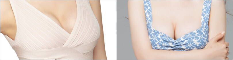 JW’s combined breast augmentation