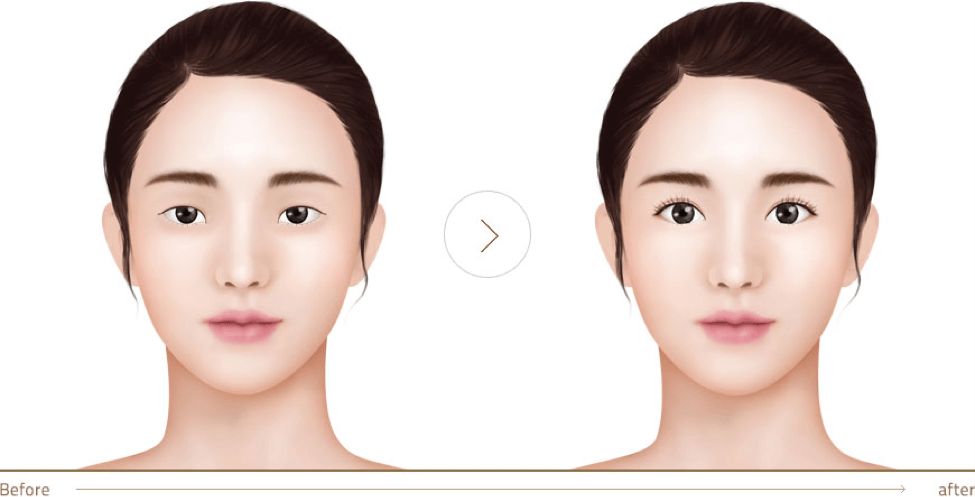 your eyelids become slim, making the lines for double eyelids natural and slim