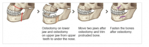 Double Jaw Surgery