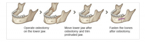 Double jaw surgery procedure