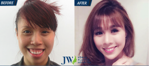 Maxillary osteotomy surgery before and after