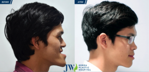Mandibular osteotomy surgery before and after