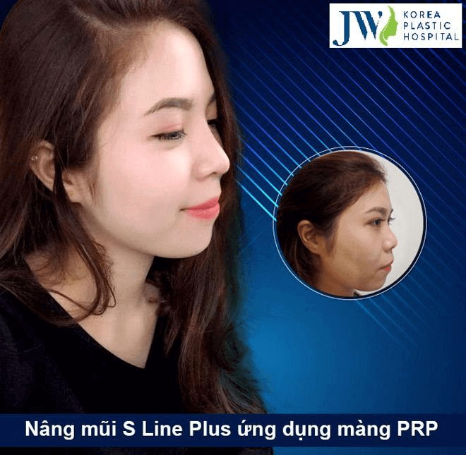 We provide the most suitable Hump nose correction procedure, considering your nose shape and conditions.