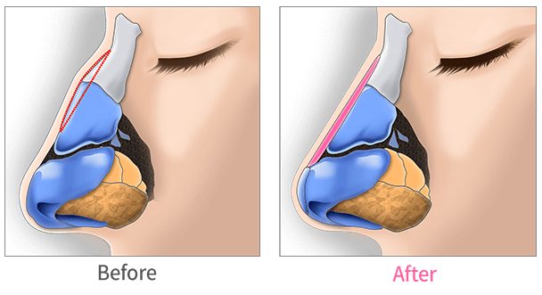 A Bump on Nasal Bridge