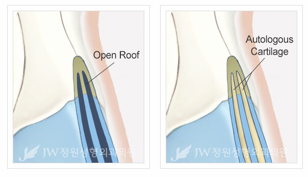hump-reduction-rhinoplasty