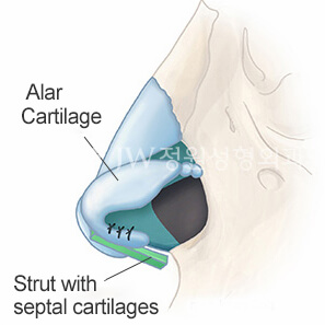 hump-reduction-rhinoplasty