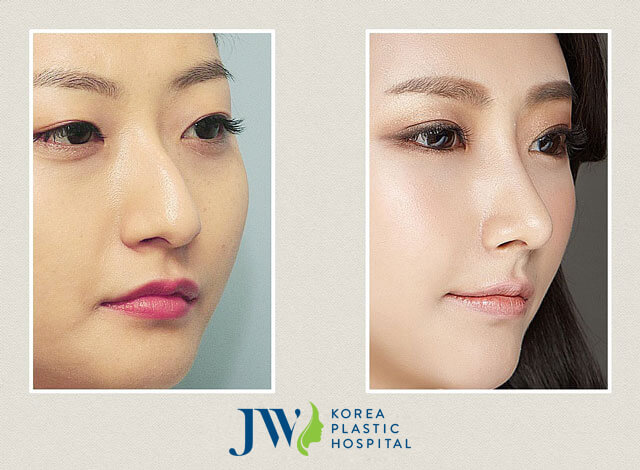 hump-reduction-rhinoplasty