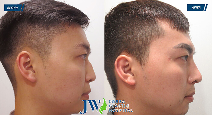 hump-reduction-rhinoplasty-8
