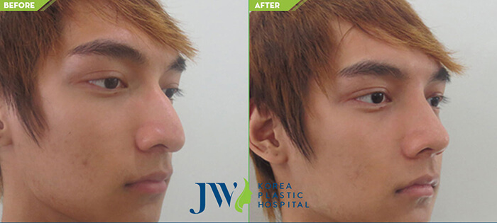 hump-reduction-rhinoplasty
