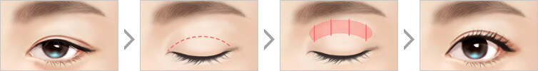 Procedure of Incision Ptosis Correction