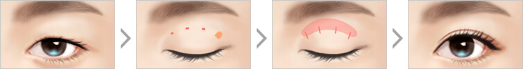 Procedure of Non-incision Ptosis Correction