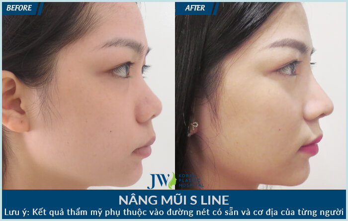 Before and After S Line Rhinoplasty