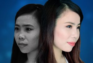 Before and After Nose Tip Correction