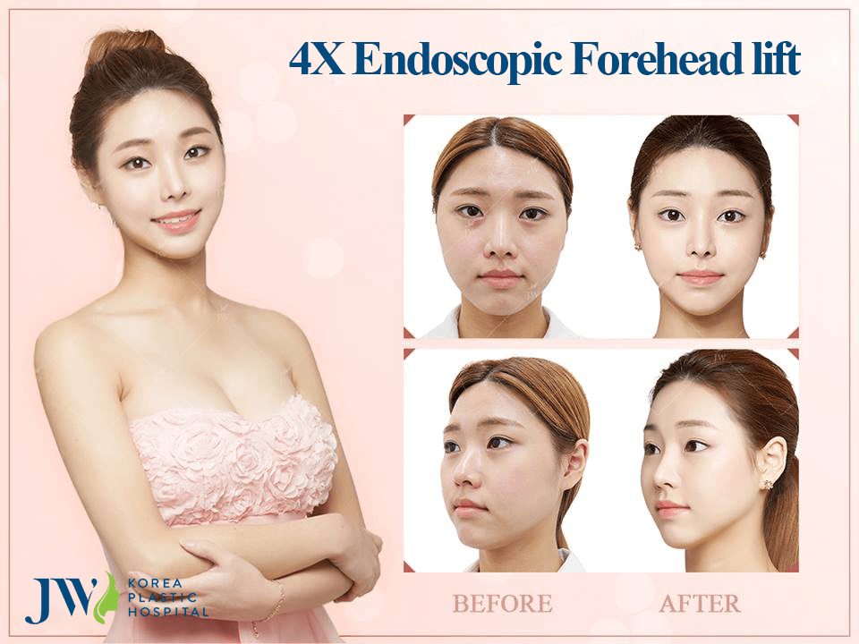 JW Hospital provides best results with 4X Endoscopic Forehead Lift in Vietnam.