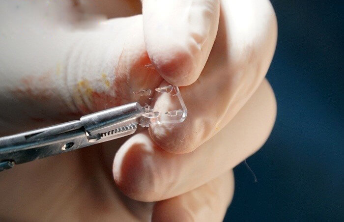 It is a medical device specifically designed for lifting skin tissue. It’s safety has been certified by the Korean Ministry of Food and Drug Safety and US FDA.