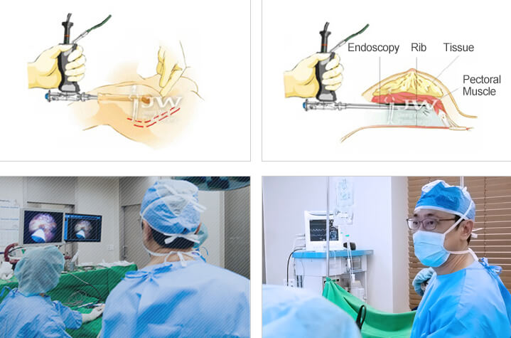 Breast augmentation using HD endoscopy equipment.