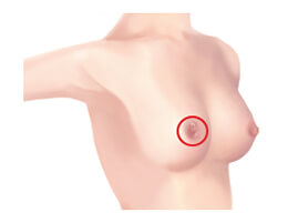 Transaxillary incision