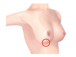 Inframammary incision