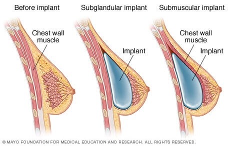 Placement of breast implants
