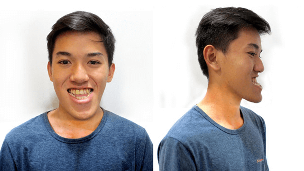 Long face and protruding jaw