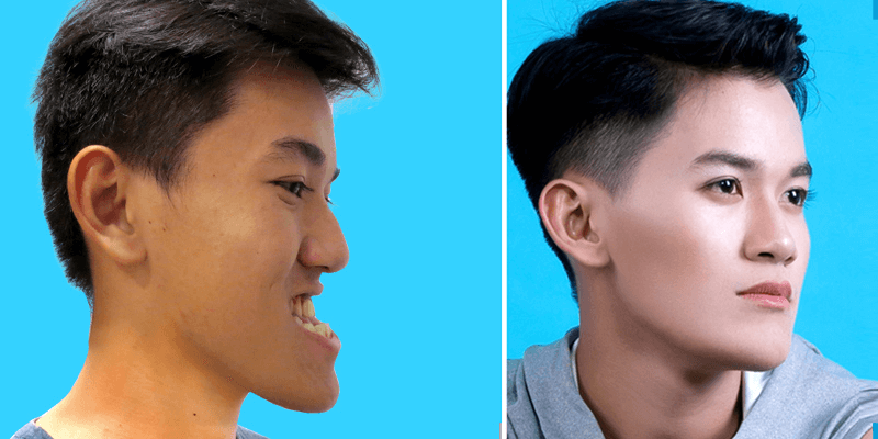 The result after jaws surgery at JW Hospital - Image 1