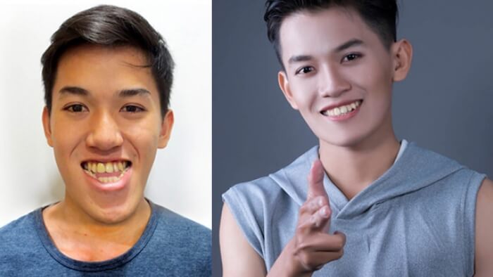 The result after jaws surgery at JW Hospital - Image 2