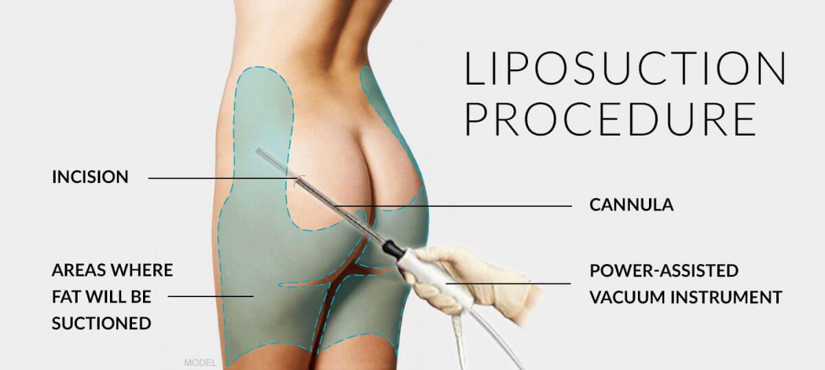 Liposuction procedure
