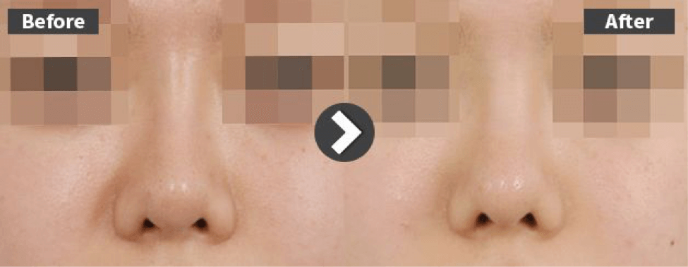 Revision for Nose ridge too high