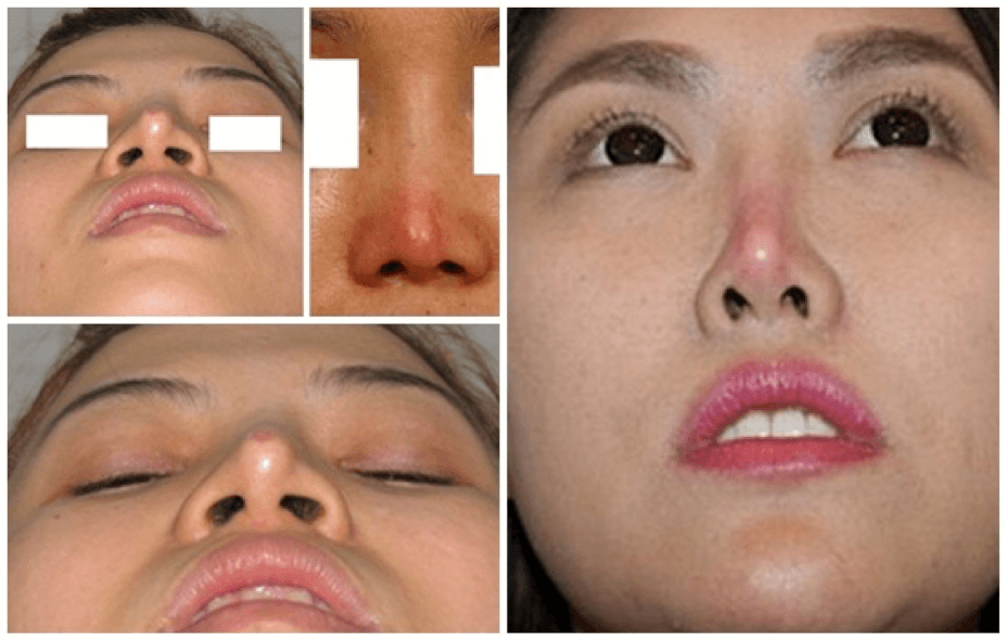 Skin turns red for nose tip