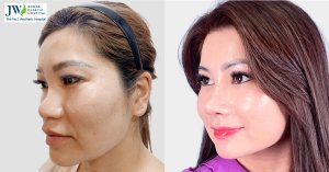Experience of Undergoing Plastic Surgery at JW Korea Hospital