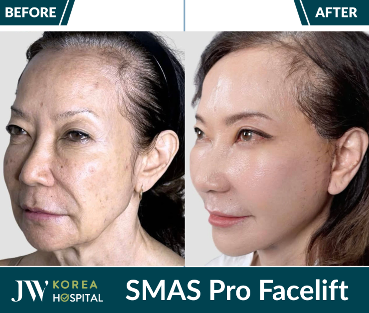 smas pro facelift in Vietnam