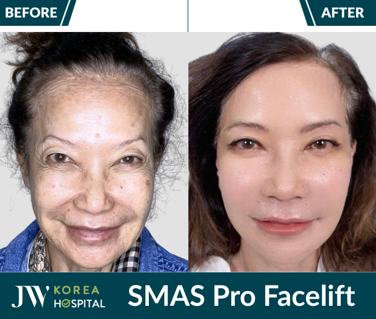 smas pro facelift in Vietnam