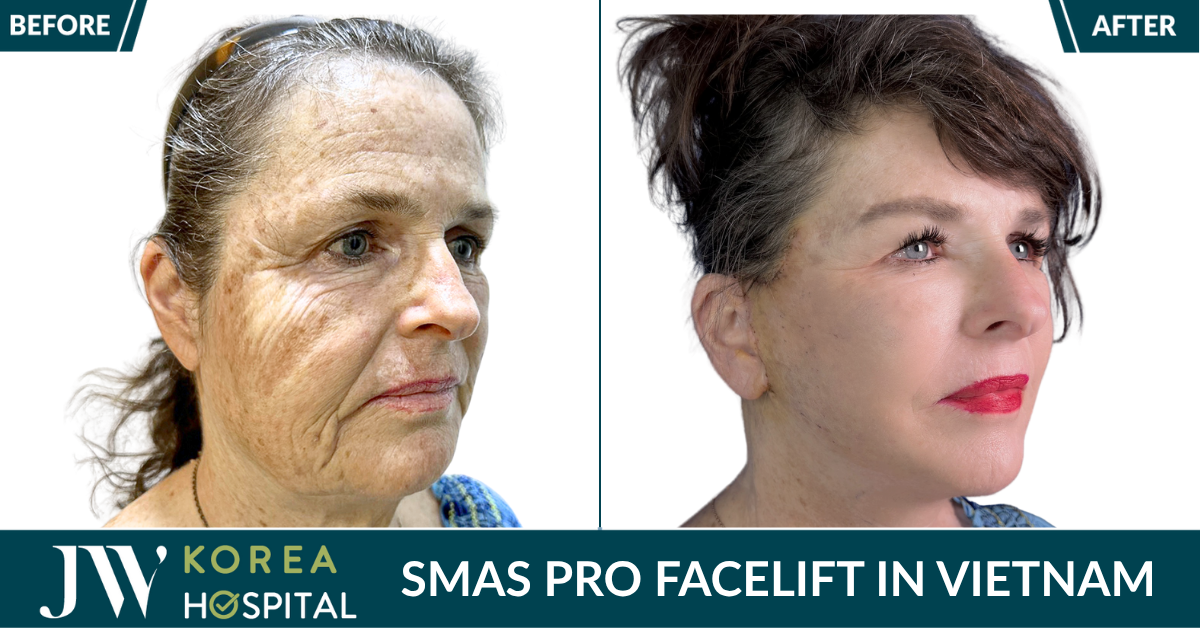 The Best Facelift in Asia – JW Korea Hospital Vietnam