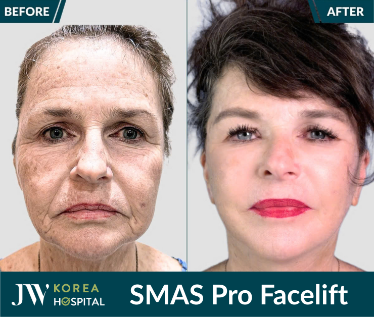smas pro facelìt 