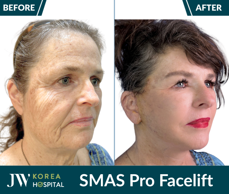 smas pro facelift 