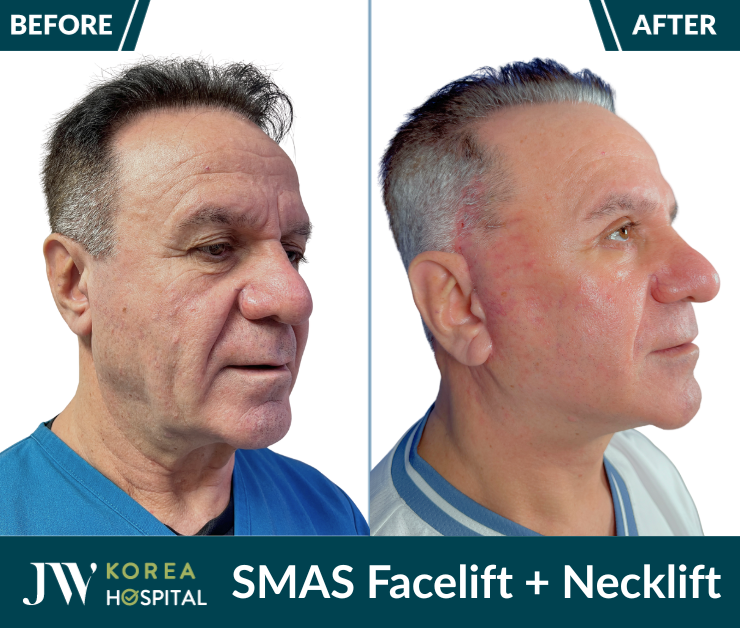 smas pro facelift necklift