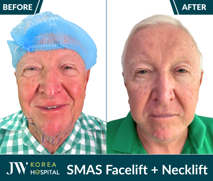 smas pro facelift necklift
