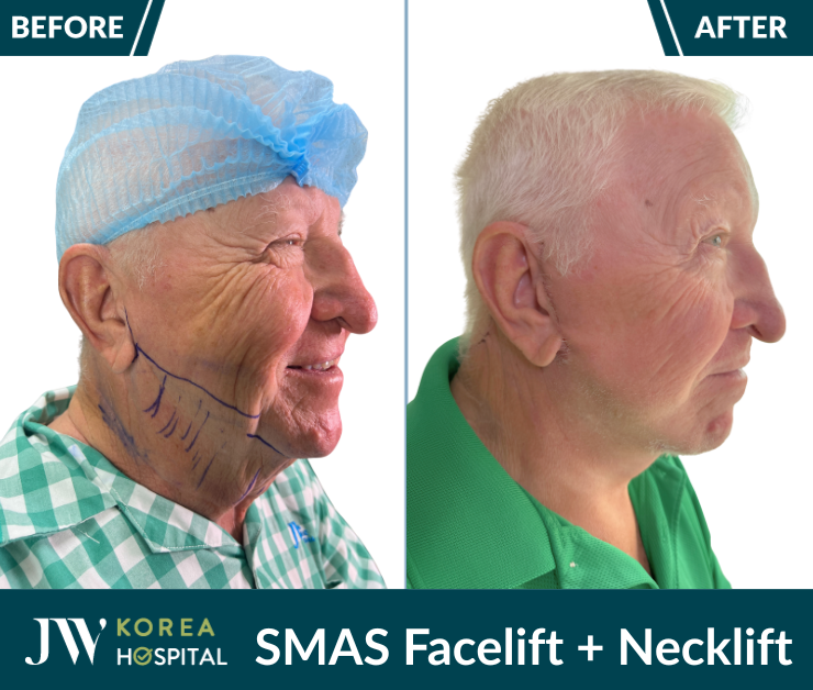 smas pro facelift necklift