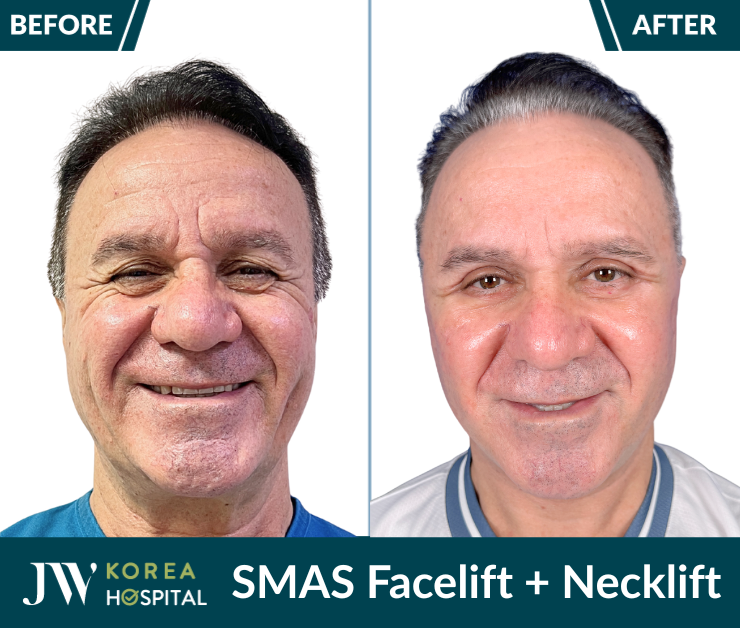 smas pro facelift necklift