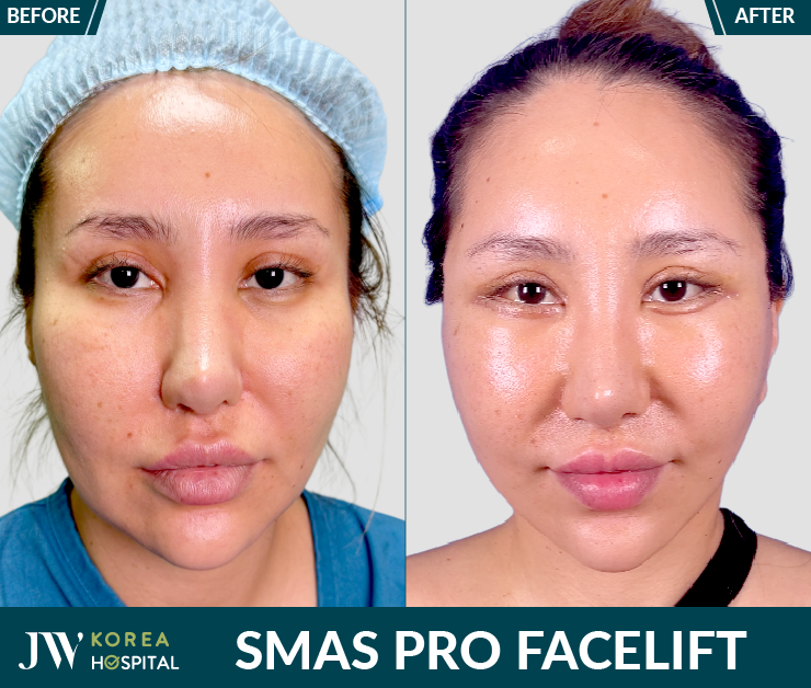 smas pro facelift method at JW Hospital