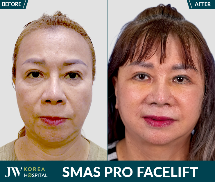 before-after smas pro facelift at JW